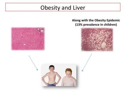 Non Alcoholic Fatty Liver Disease In Children